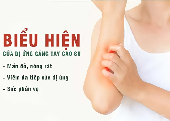 Dị ứng găng tay thực phẩm cao su - Nguyên nhân và cách phòng tránh